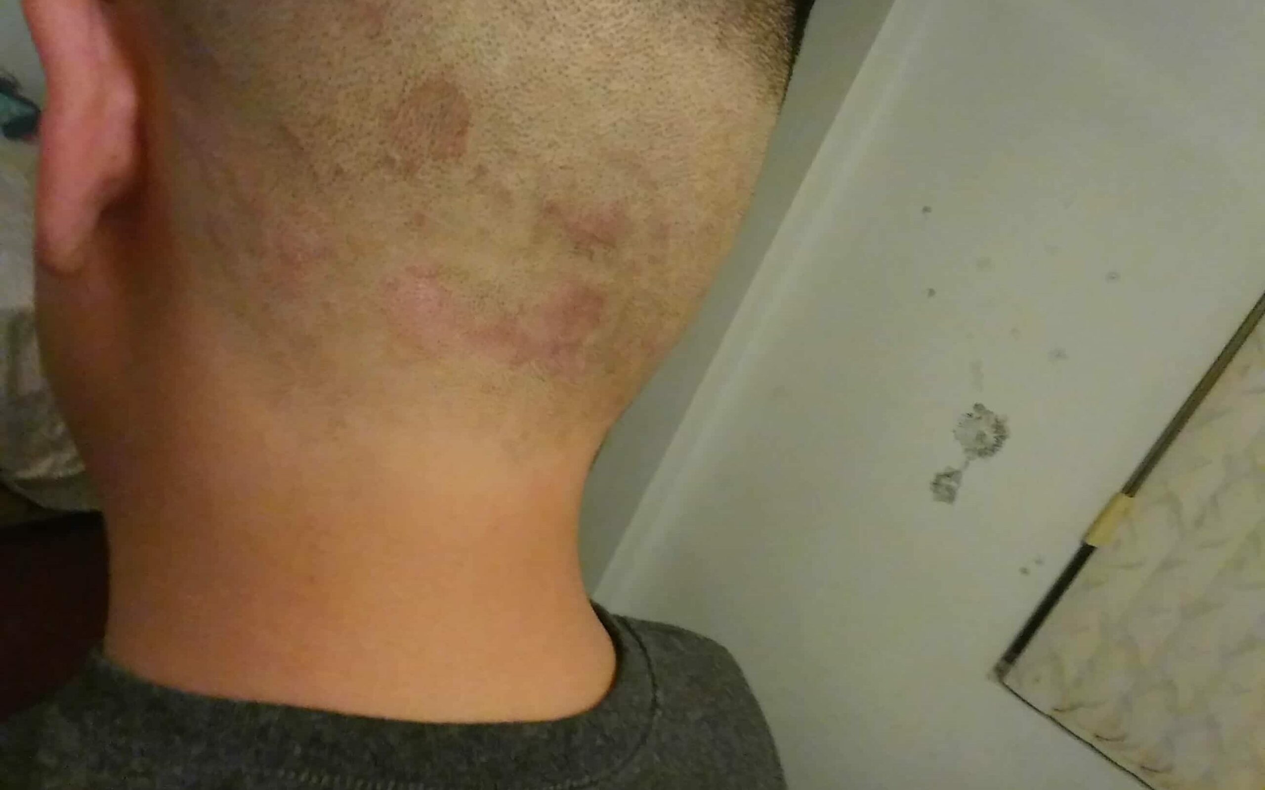 Allergic reactions