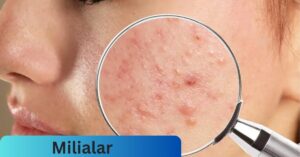 Milialar